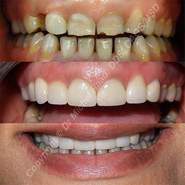 before, during, and after example of a full-smile reconstruction from Luxor Dental in San Ramon and Pleasanton, CA